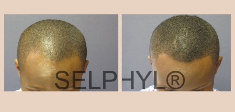 PRFM Hair Loss Before And After images white plains